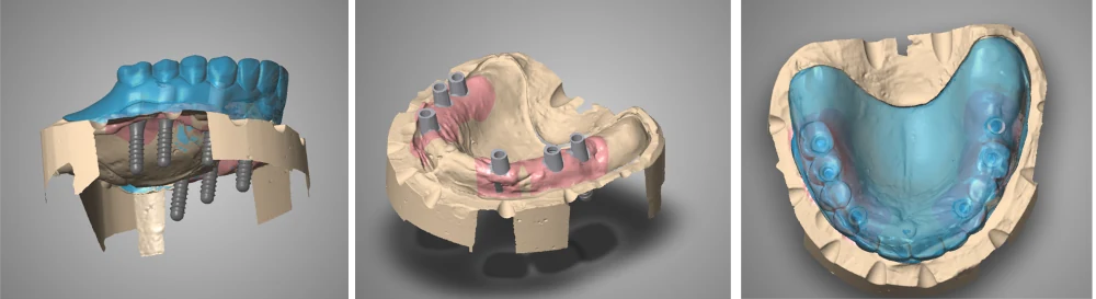 Drei Ansichten der geplanten teleskopierenden Versorgung auf den Implantaten