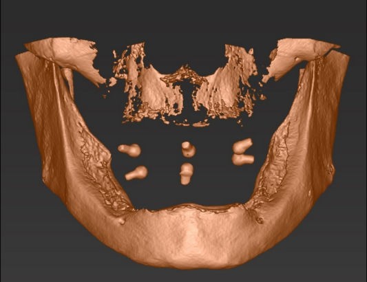 3D-Ansicht des Kiefers aus dem Röntgenbild mit den freigelegten Röntgenkugeln
